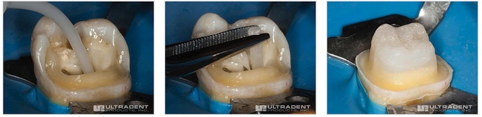 Permaflo DC: Versatile Cementation