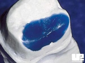 Ultradent™ LC Block-Out Resin