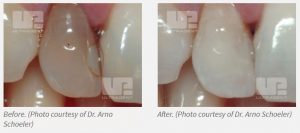 Opalescence Endo Non-Vital Walking Bleach Results