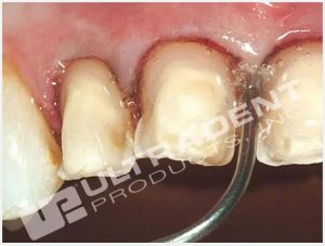 Viscostat Clear 25% Aluminum Chloride Hemostatic